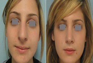 Nose Job surgery price in Iran Surgery Center