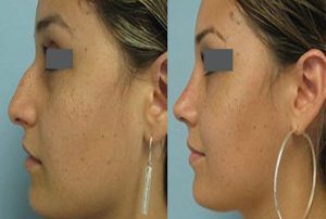 rhinoplasty in iran