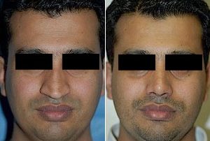 Septoplasty surgery in Iran