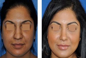 rhinoplasty in iran