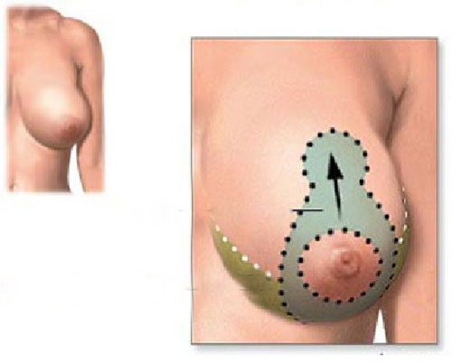 Breast Reduction in Iran