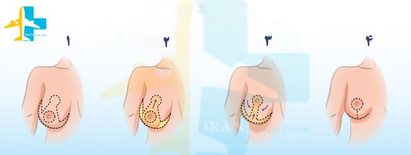 Breast Reduction procedure in Iran