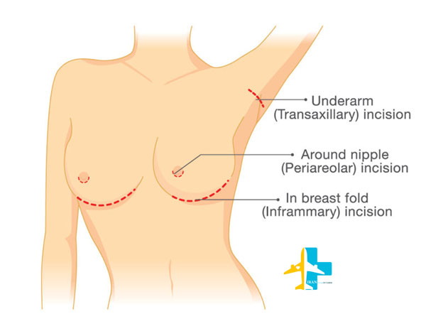 breast augmentation surgery