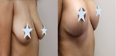 breast lift surgery in Iran