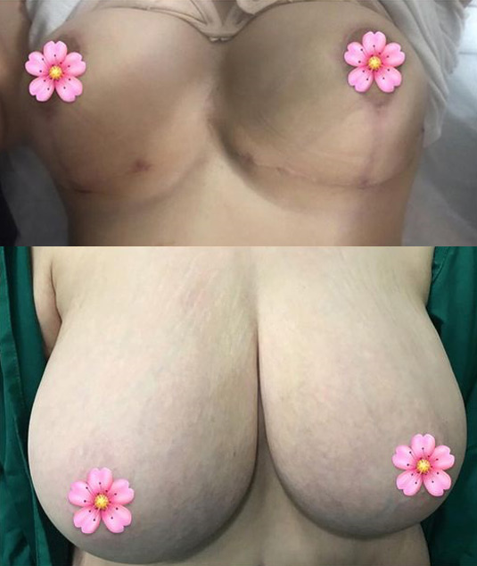breast reduction surgery in iran