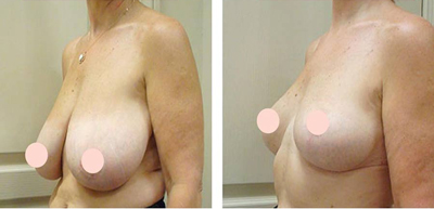 breast reduction and breast lift in iran