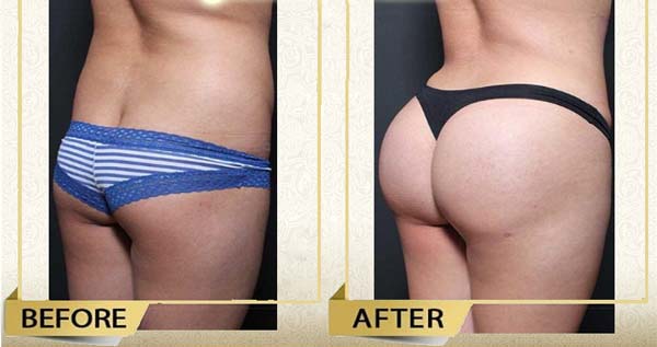 Buttock Enhancement