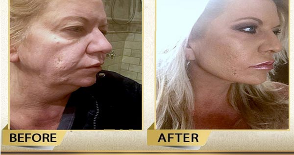 facelift surgery and neck lift in Iran