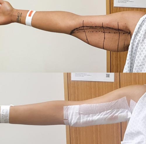 arm lift surgery Iran