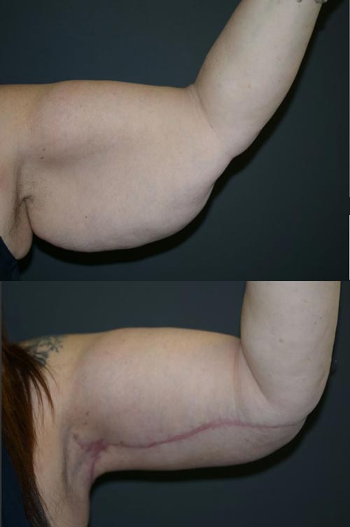 Arm reduction Surgery