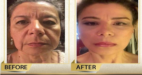 facelift and neck lift in Iran