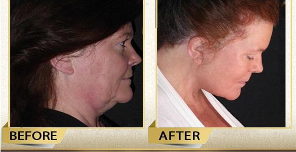 facelift surgery price in Iran