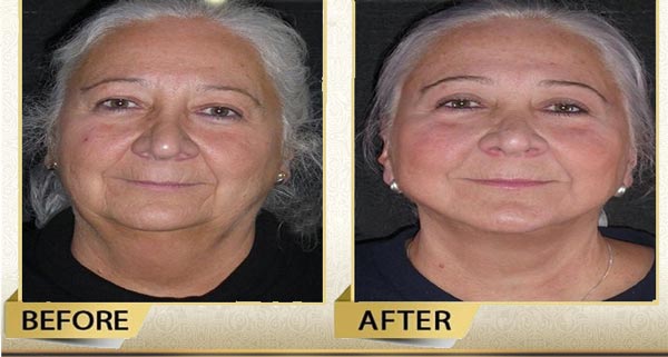 facelift and neck lift surgery in Iran