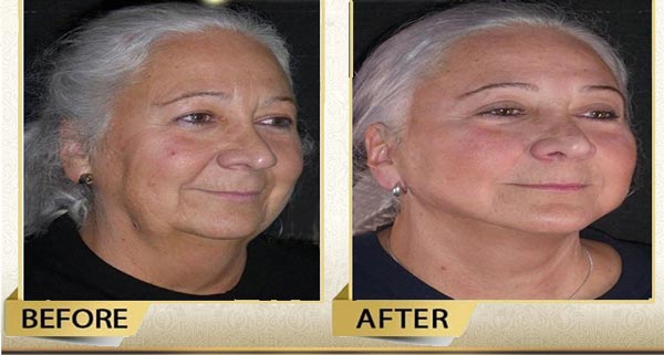 facelift surgery in Iran