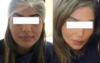 Celebrity Cheek Surgery in Iran
