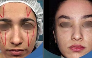 endoscopic Forehead lift Surgery Iran