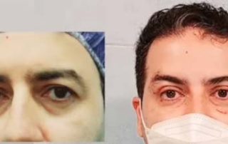 Forehead lift procedure Iran