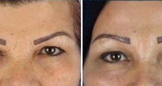 browlift in Iran