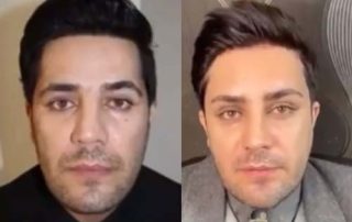 Forehead lift Surgery in Iran