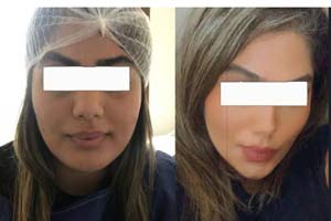Celebrity Cheek Surgery Iran