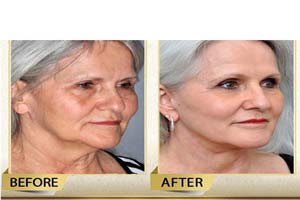 face lift and neck lift in Iran