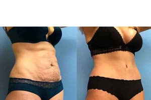 extended tummy tuck in Iran