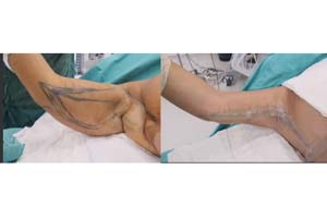 arm skin removal surgery Iran