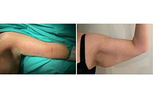 arm reduction surgery Iran