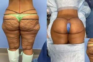 fda approved buttock injections Iran