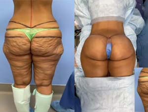 fda approved buttock injections Iran