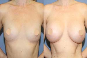 Breast Implants Iran