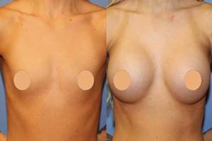 breast augmentation Iran