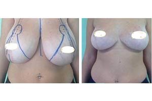 boob lift surgery price Iran
