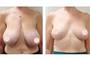 sagging breast treatment Iran