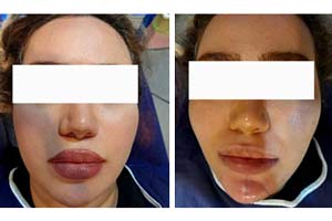 buccal fat removal Iran