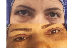 eyelid surgery Iran