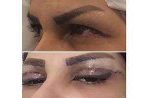 hooded eye surgery Iran