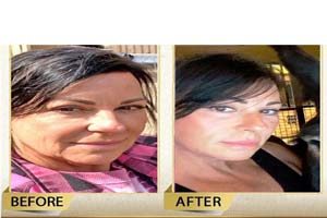 facelift surgery in Iran