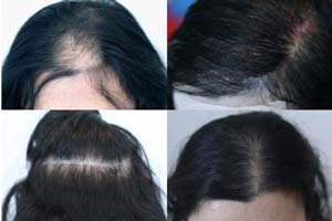 hair transplant Iran