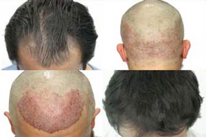 Hair Transplant in Iran Recovery