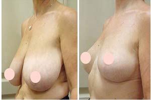 Breast lift surgery Iran