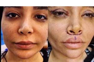 Lip Injections & Fillers Iran