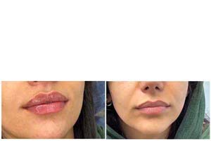 central lip lift surgery in Iran