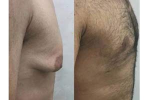 Breast Reduction surgery for male Iran