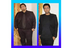 Gastric sleeve in Iran