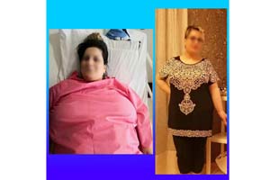 Gastric Bypass in Iran