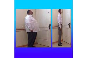 Gastric Sleeve surgery in Iran