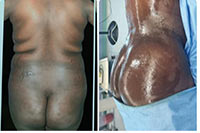 Brazilian Butt Lift in Iran