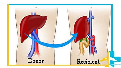 Liver transplantation with a living donor