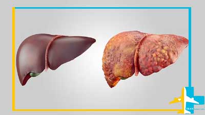 Healthy liver and liver cirrhosis